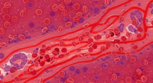 Improving Blood Flow to Relieve Diabetic Nerve Pain